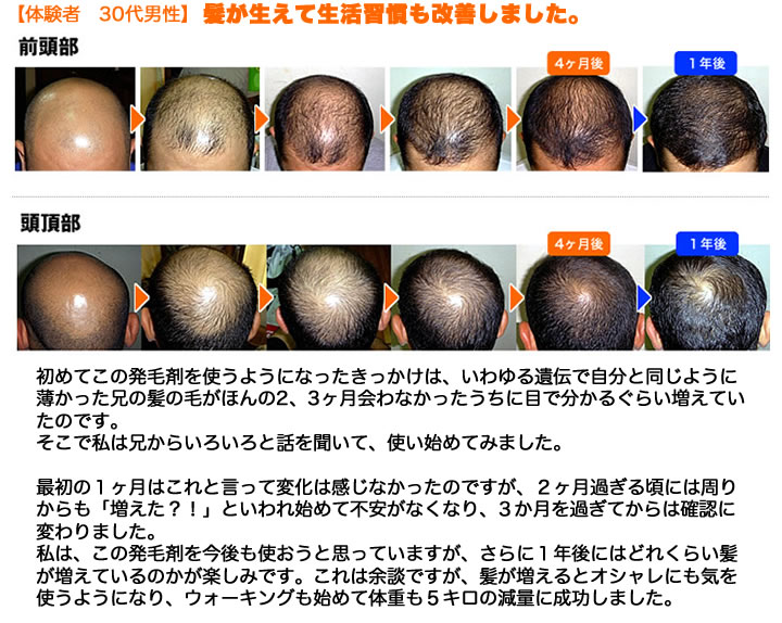 お客様の声。髪が生えて生活習慣も改善しました。